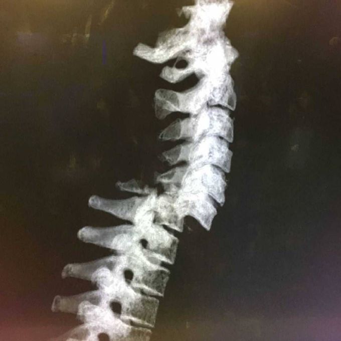 Fracture of the vertebral column