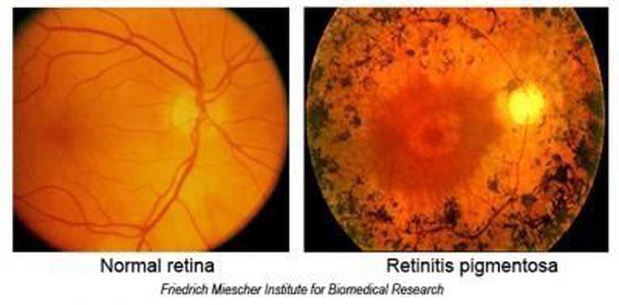 Retinitis pigmentosa