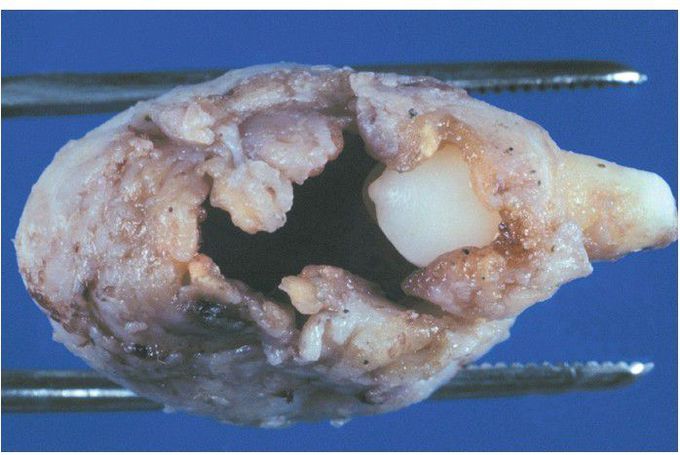 Dentigerous Cyst.