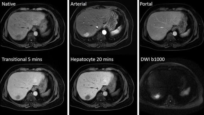 Gadoxetate Disodium–Enhanced MR Imaging of the Liver&nbsp;