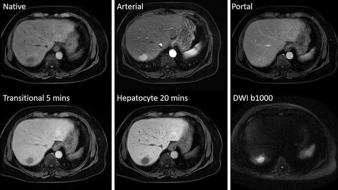 Gadoxetate Disodium–Enhanced MR Imaging of the Liver&nbsp;