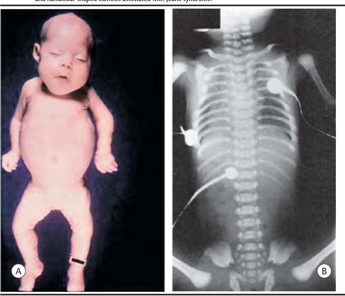Jeune syndrome