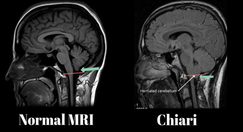 MRI Arnold Chiari Malformation Type Ll MEDizzy