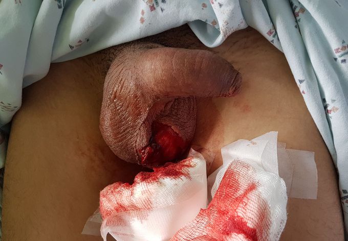 Testicle Trauma in adolescent patient.