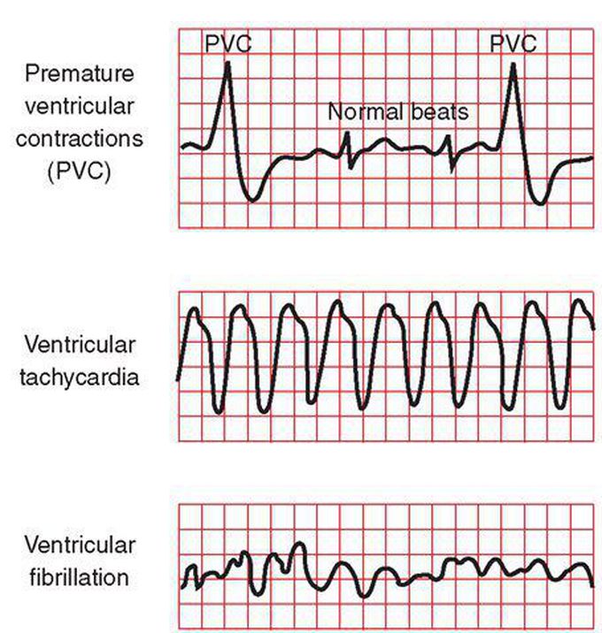 Ecg view
