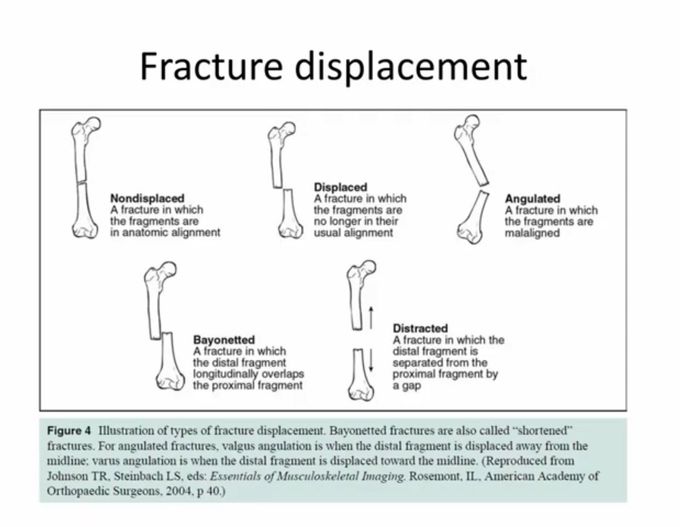 Fracture