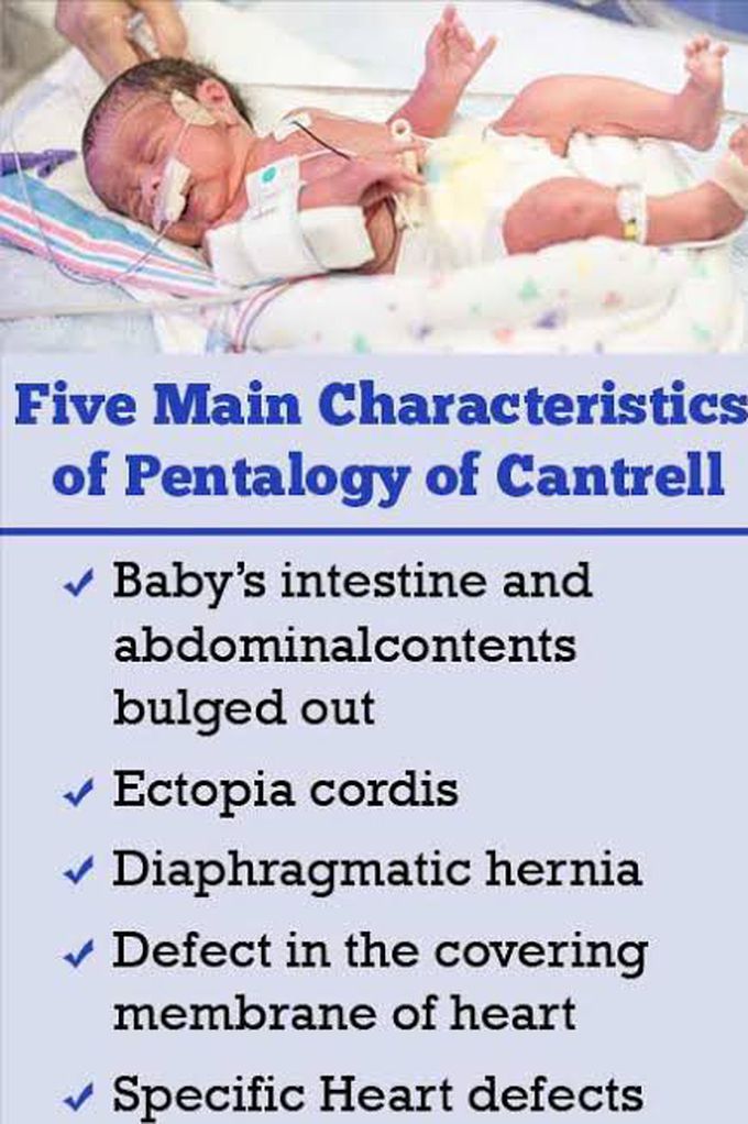 These are the main characteristics of Pentalogy of cantrell
