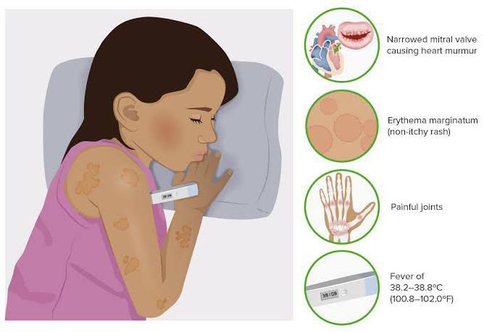 Symptoms of rheumatic fever