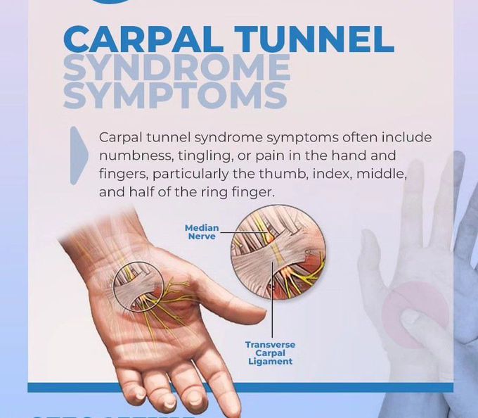 Carpal Tunnel Syndrome