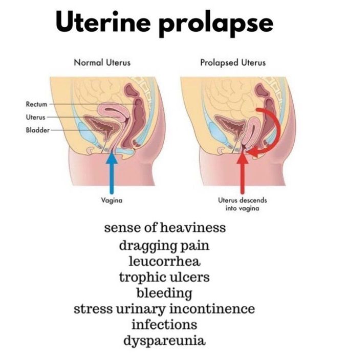 Uterine Prolapse