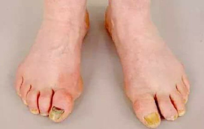 This gentleman was reviewed in the respiratory clinic. Which is the most likely diagnosis?
1) Asthma
2) Pulmonary fibrosis
3) Bronchiectasis
4) Cystic fibrosis
5) Lymphoma