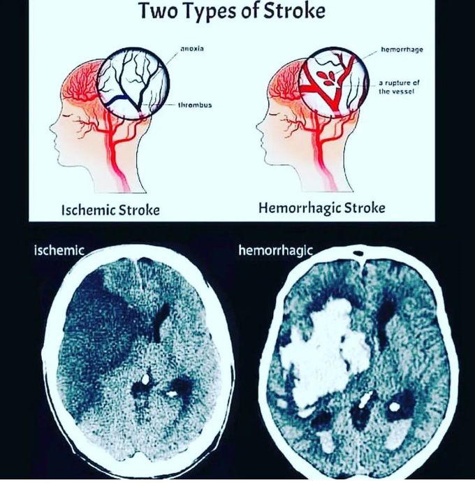 Types of Stroke