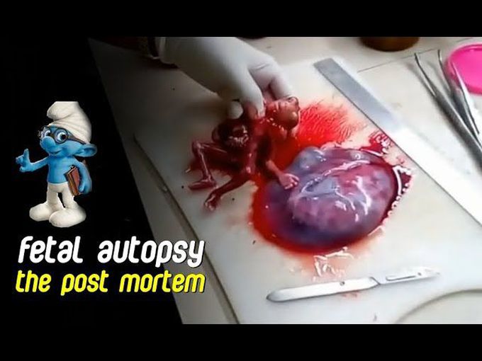 Fetal Autopsy : The Post Mortem