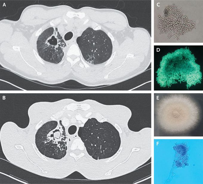 Pulmonary Aspergilloma