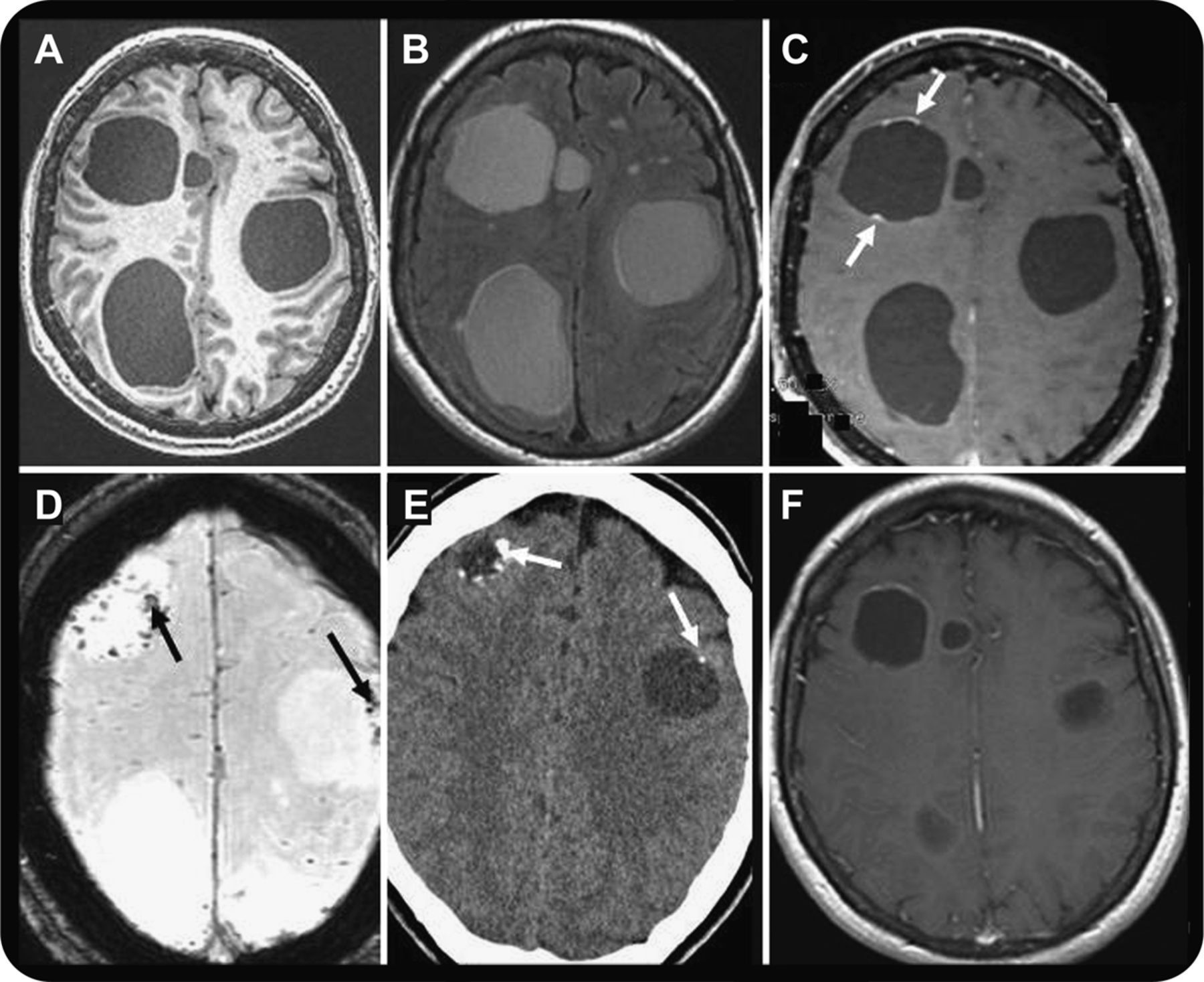 metastatic-breast-cancer-medizzy