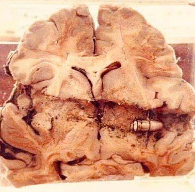 A bullet in the brain!