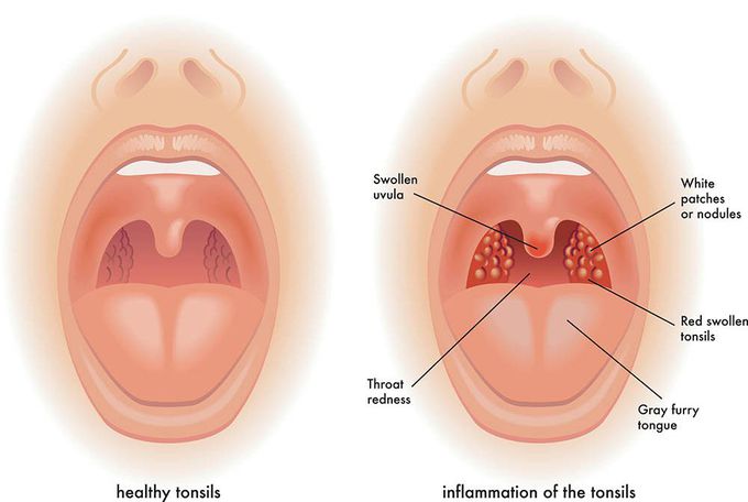 Tonsillitis