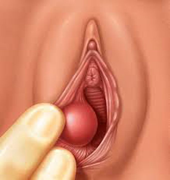 What is a vaginal cyst?