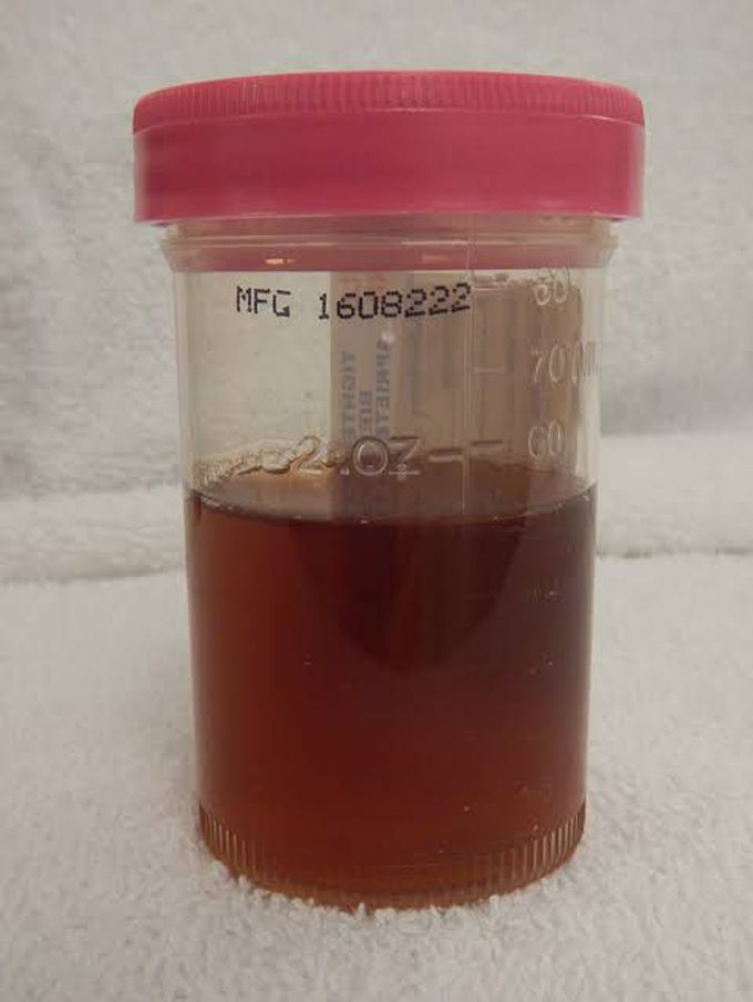 Hematuria