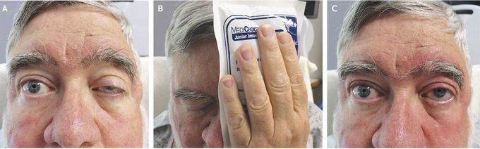 Diagnosing Myasthenia Gravis with an Ice Pack