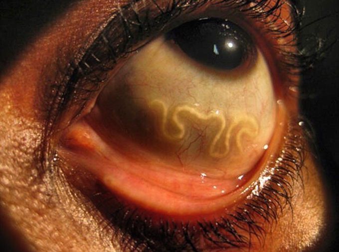 Loa Loa filariasis nematode