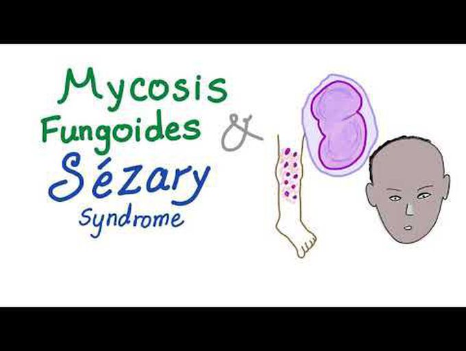 Pathology (Mycosis fungoides)