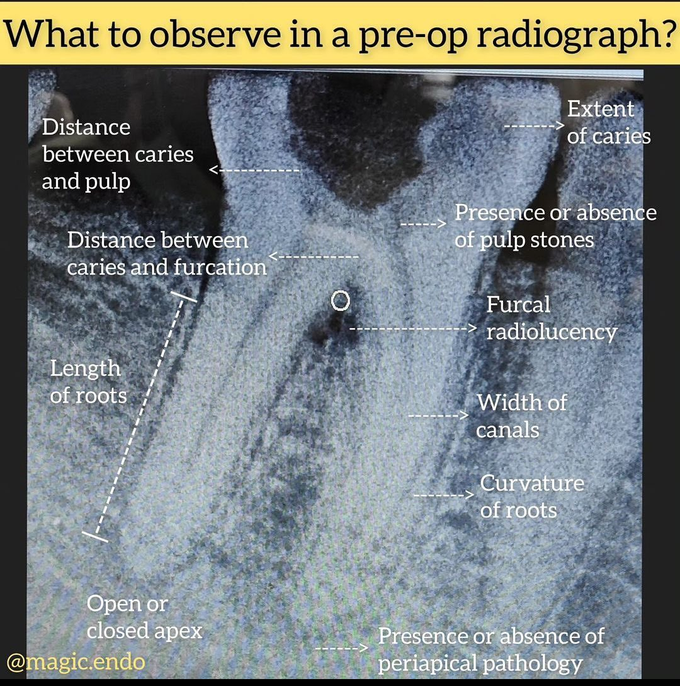 What to observe in a pre-op radiograph