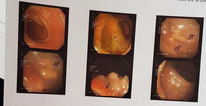 Colonoscopy