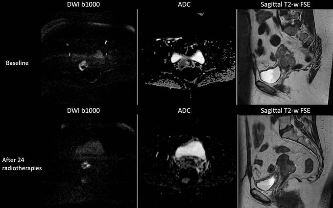 The value of MR diffusion-weighted imaging (DWI) in monitoring the response to treatment in cervical cancers