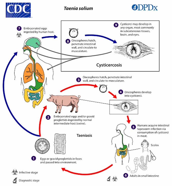 Cysticercosis