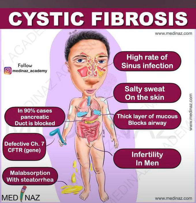 Cystic fibrosis-Mnemonic