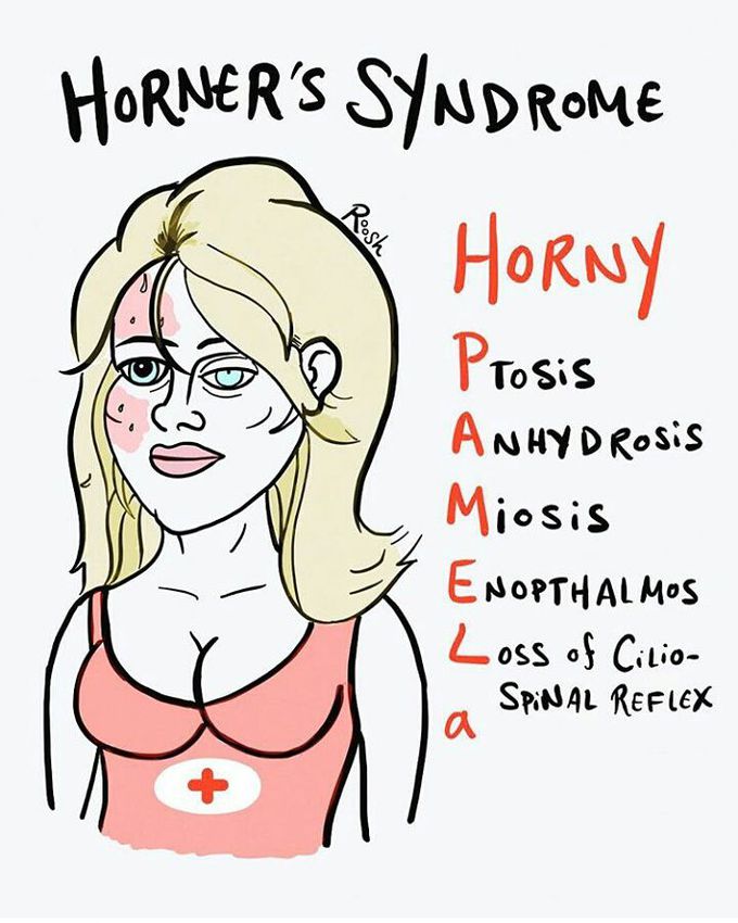 Horner's syndrome mnemonic