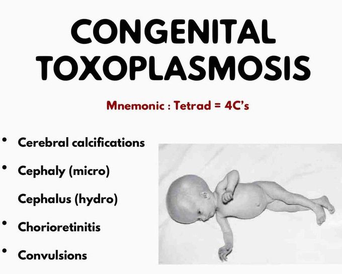 Congenital Toxoplasmosis