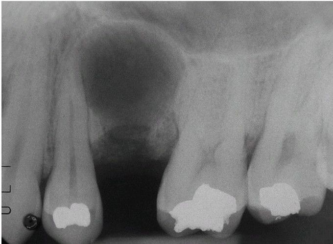 Residual Periapical Cyst