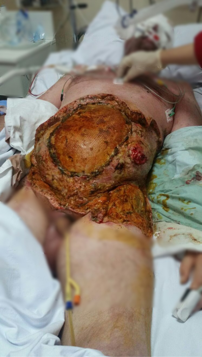 Severe case of pemphigus vulgaris!