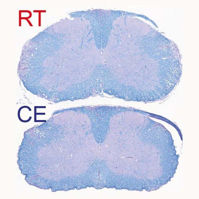 Fighting Multiple Sclerosis With Cold - Neuroscience News