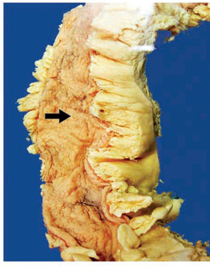 Ulcerative colitis.