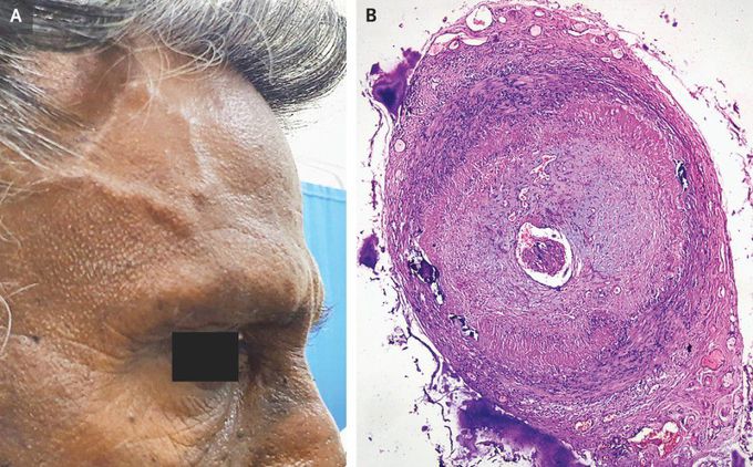 Giant-Cell Arteritis