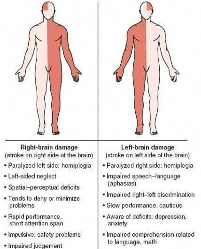 Difference between right and left brain damage