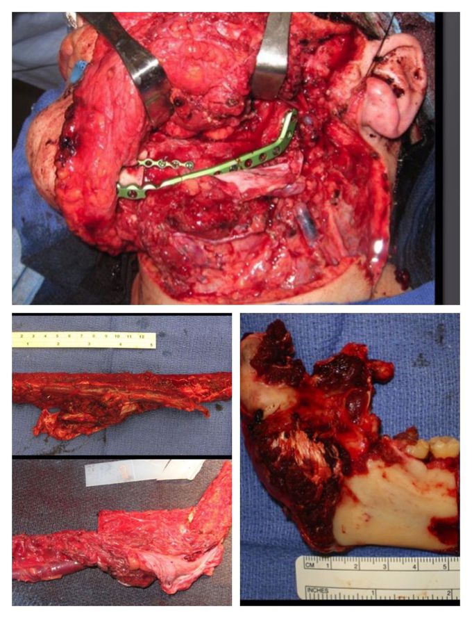 Oral and maxillofacial surgery