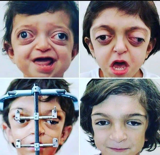 Crouzon syndrome treatment