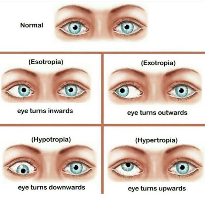 Strabismus