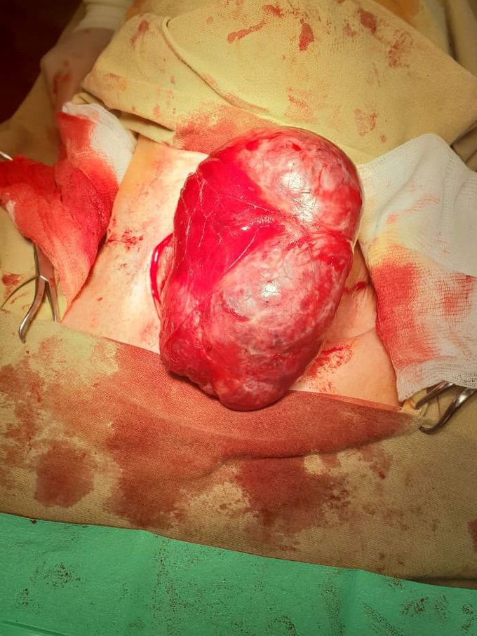 Total thyroidectomy about goiter