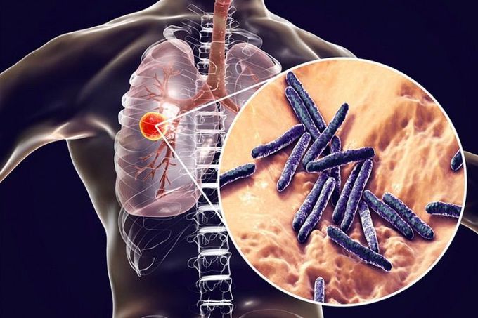 tuberculosis-tb-1-medizzy