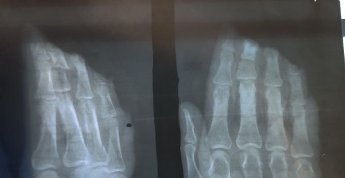 Traumatic Amputation of tips of Phalanges