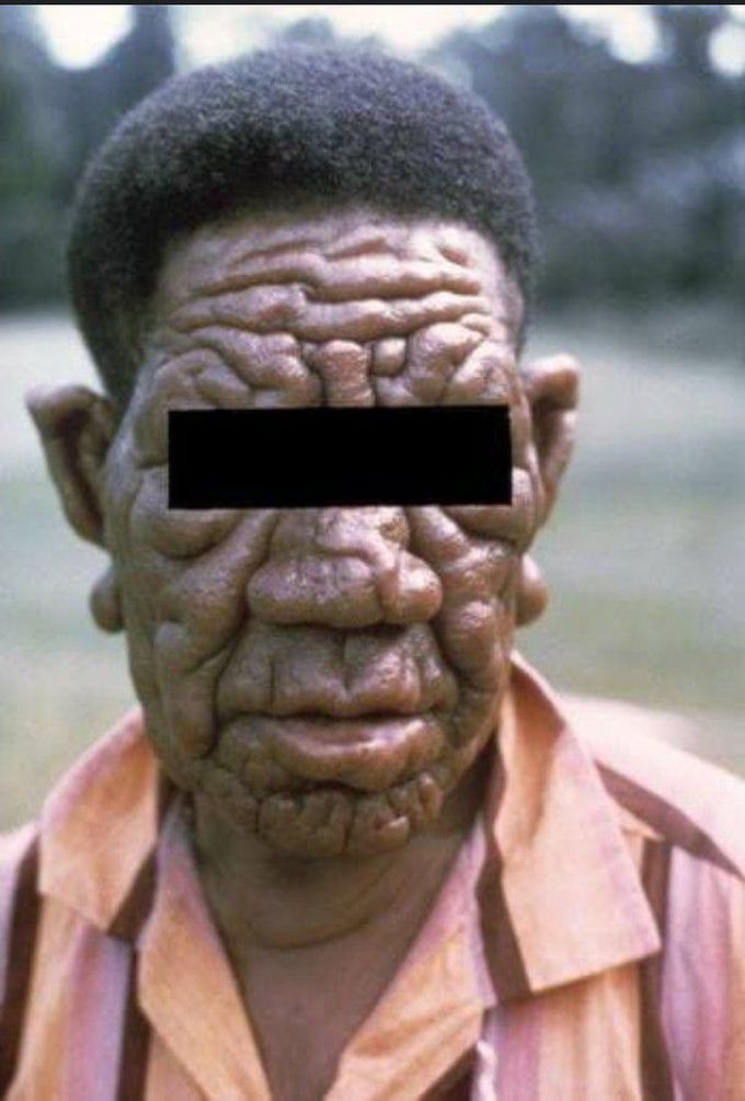 Leonine facies in leprosy