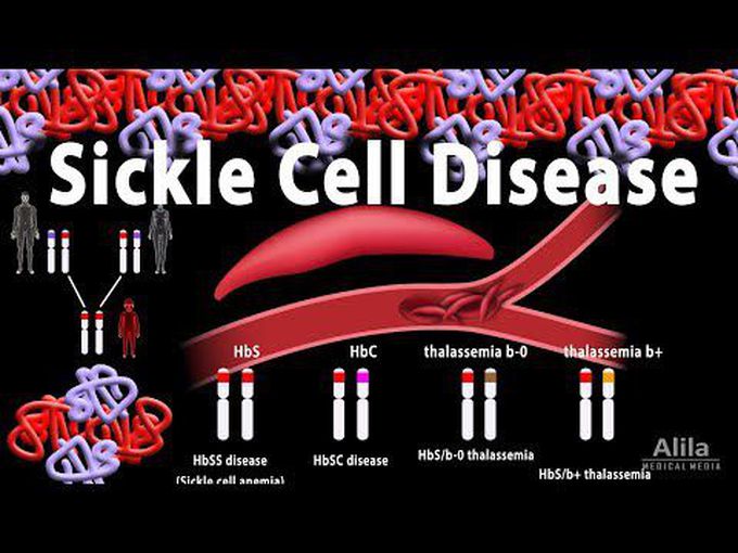 Animation - Sickle Cell Anemia