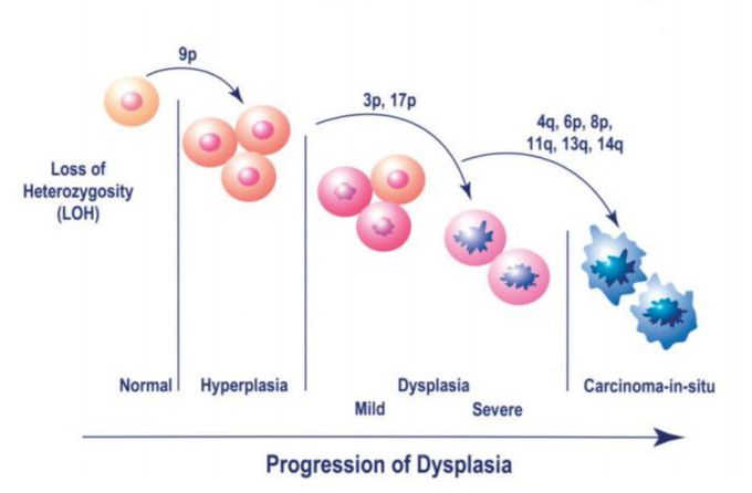 Dysplasia