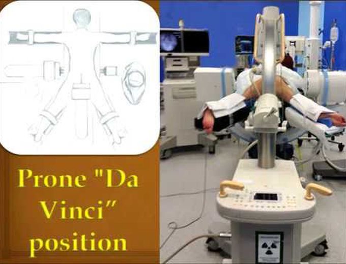 Biplanar x-ray fluoroscopy for sacroiliac joint fusion