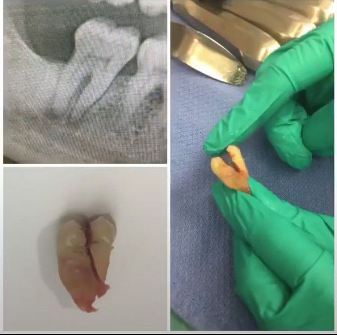 Widened PDL and bone loss